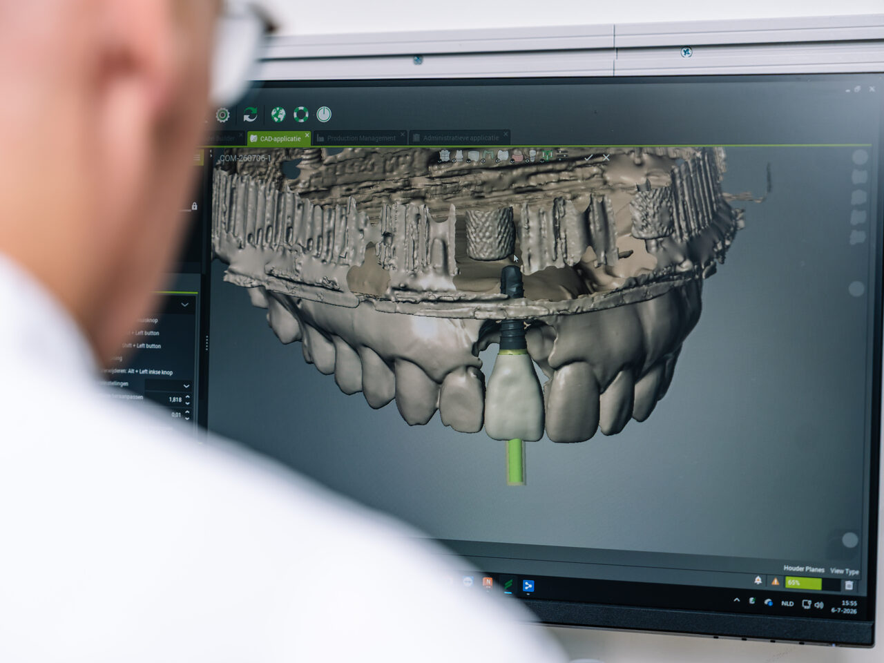 Digitaal ontwerp van een implantaatopbouw in CAD-software met een 3D-scan