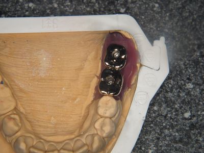 Werkmodel bovenkaak met twee geschroefde metalen kronen in de zijdelingse delen