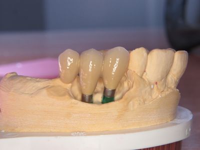 Twee implantaatkronen op titanium abutments, zijaanzicht