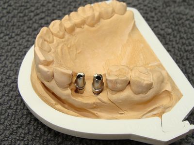 Werkmodel met twee titanium abutments in de zijdelingse delen