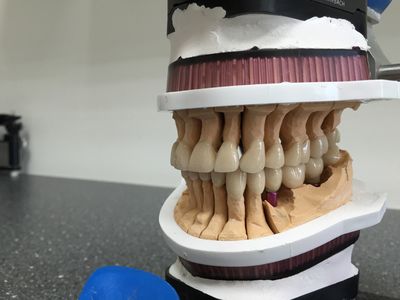 Boven- en onderopstelling in de articulator