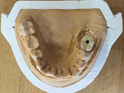 Werkmodel met implantaatabutments naast de natuurlijke elementen