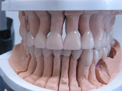 Zaagmodel in de articulator, boven- en onderkaak in occlusie