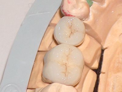 Twee molaarkronen op het zaagmodel, close-up
