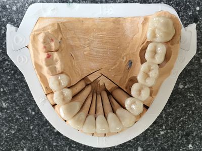 Zaagmodel bovenkaak met afgewerkte kronen links en rechts