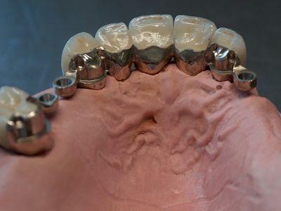 Metalen onderstructuur met opgebakken porselein op het gingivamodel