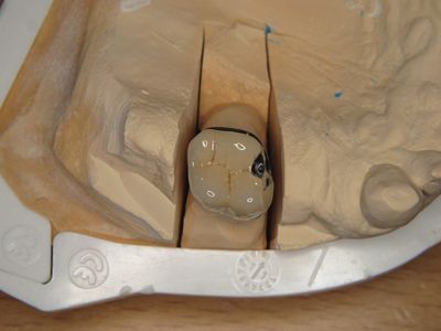 Kroon met metalen kauwvlak op de stomp, detail