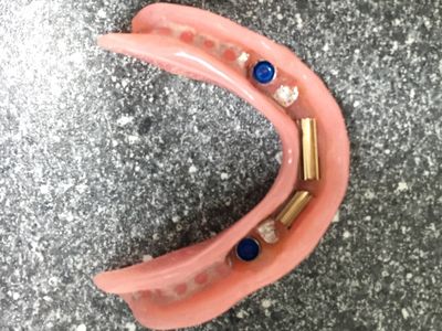 Onderzijde van een overkappingsprothese met stegkokers en retentiematrices