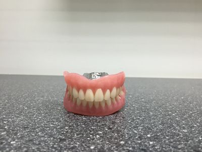 Volledige boven- en onderprothese met metalen gehemelteplaat, vooraanzicht