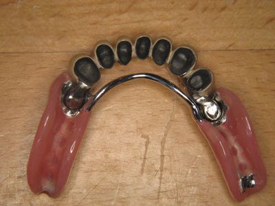 Onderprothese met metalen versteviging