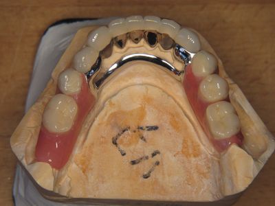 Partiële bovenprothese met metalen frame op een gipsmodel