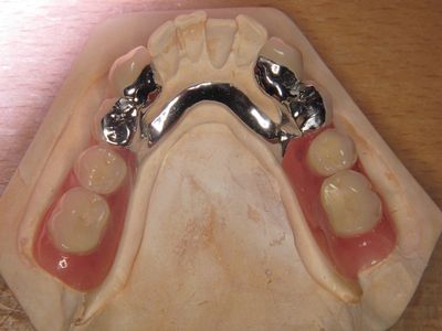 Partiële bovenprothese met metalen gehemelteplaat