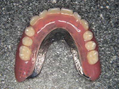 Onderprothese met metalen basis