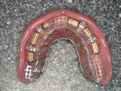 Onderprothese met goudkleurige implantaatbevestigingen