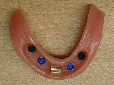 Onderprothese met gekleurde inzetten voor de bevestiging