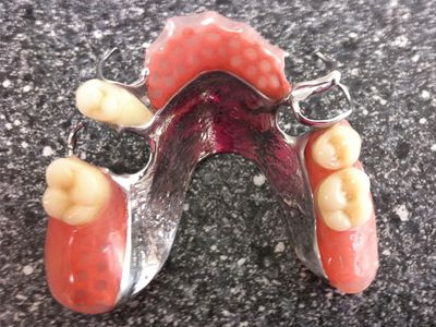 Partiële prothese met metalen frame