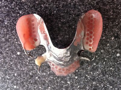 Partiële prothese met metalen frame en klammeren