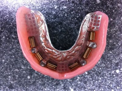 Onderprothese met metalen versteviging en implantaatbevestigingen