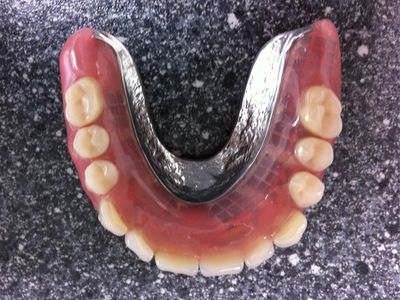 Onderprothese met metalen basis en elementen