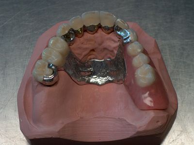 Partiële bovenprothese met een uitgebreid metalen frame op een gipsmodel