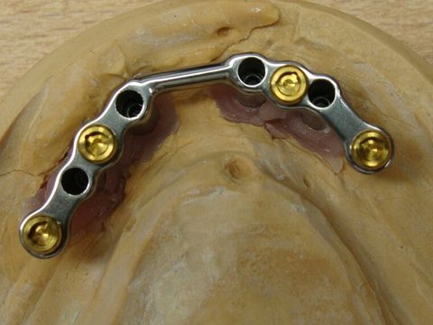Implantaatconstructie met titanium brug